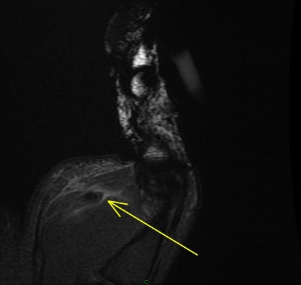 Figure 6 for case Flexor pollicis longus tendon ( RID2383 ) laceration